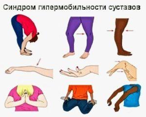 sindrom-gipermobilnosti-sustavov-4-300x240.jpg