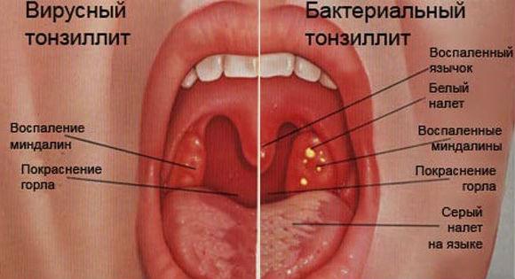 angina_virusnaya_i_gnojnaya.jpg