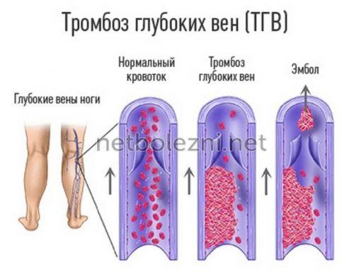 1497740109_tromboz-glubokih-ven.jpg
