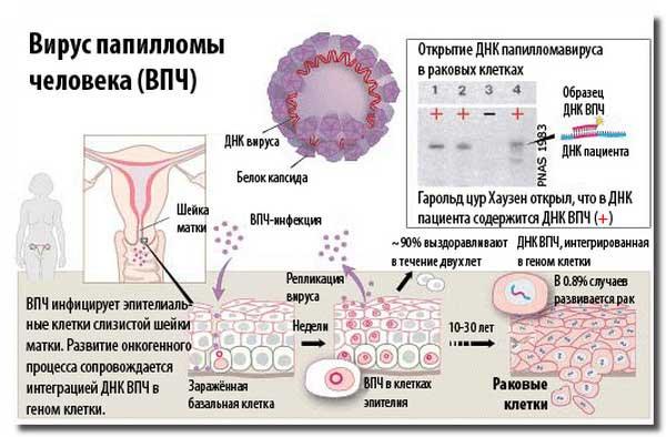 вирус папилломы человека и беременность