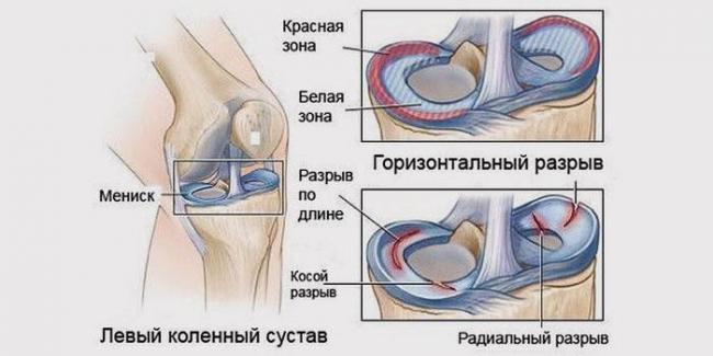 6128339-5travma-meniska.jpg