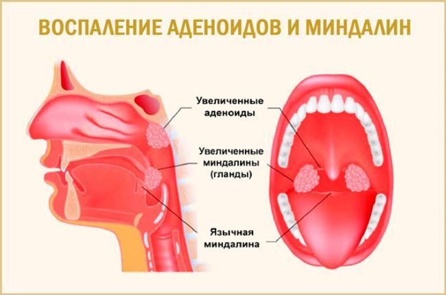 hrapit-posle-udaleniya-adenoidov_23.jpg
