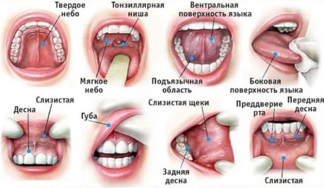 Lokalizatsiya-raka-v-polosti-rta-e1519012126188-670x390.jpg