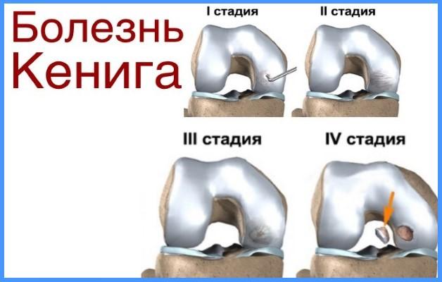 bolezn-Keniga-1.jpg