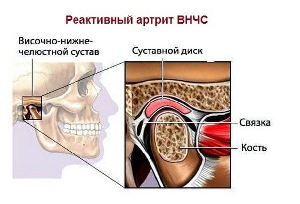 Artrit-vnchs.jpg