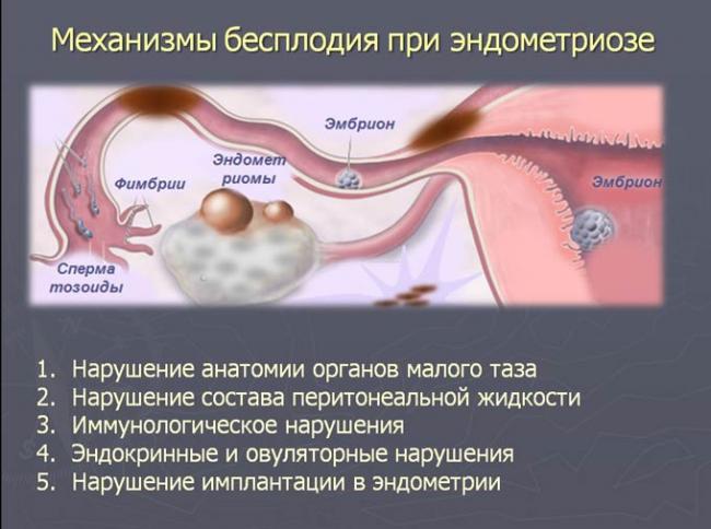 бесплодие при эндометриозе