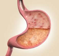 gastrit-1.jpg