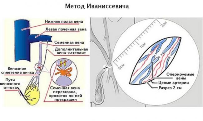 метод иваниссевича