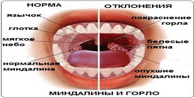 Giper-vospalyonnye-adenoidy-v-detskoj-nosoglotke.png