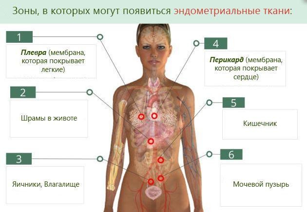 зоны эндометриальных тканей