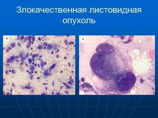 снимок опухоли