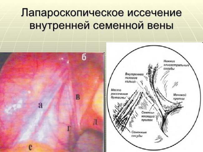 варикоцеле лапароскопия