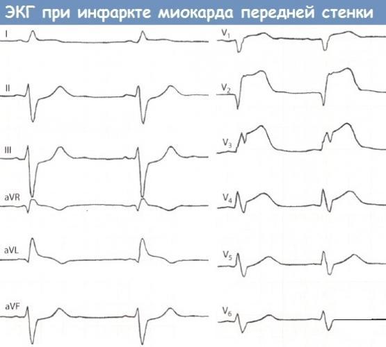 экг-инфаркта-миокарда-передней-стенки.jpg