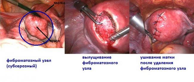 удаление фиброматозного узла