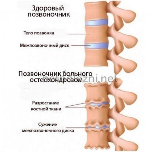 1497736555_osteohondroz.jpg