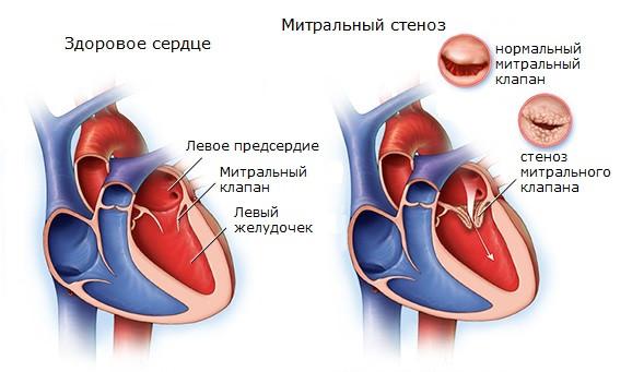 dilatacija_levogo_predserdija_stenoz.jpg