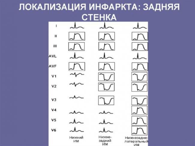 локализация-инфаркта-задняя-стенка.jpg