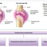 osteoartroz-150x150.jpg