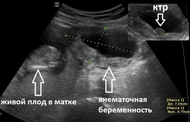 может ли быть внематочная беременность после эко