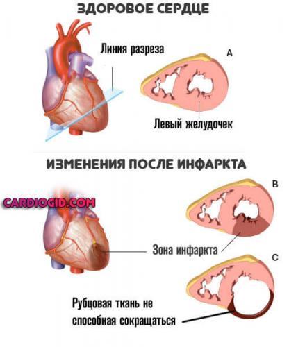 kardioskleroz-posle-infarkta.jpg
