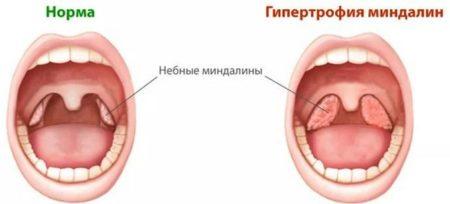 Geneticheskaya_predraspolozhennost_hrapa_u_detey_1-450x204.jpg