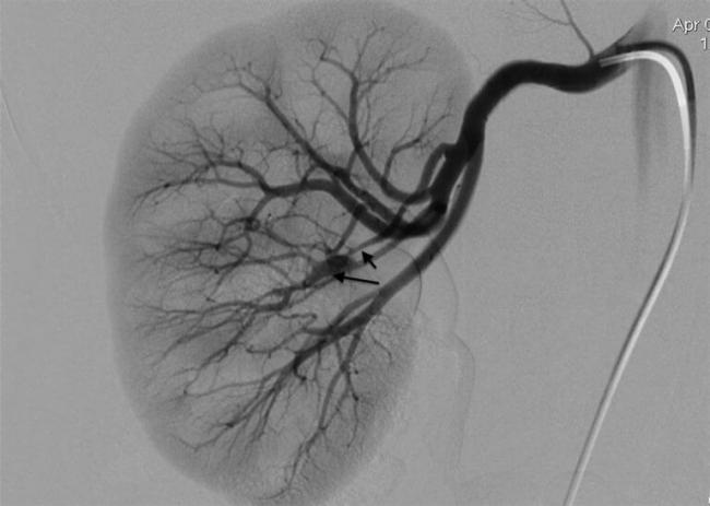 angiografiya-pochek.jpg