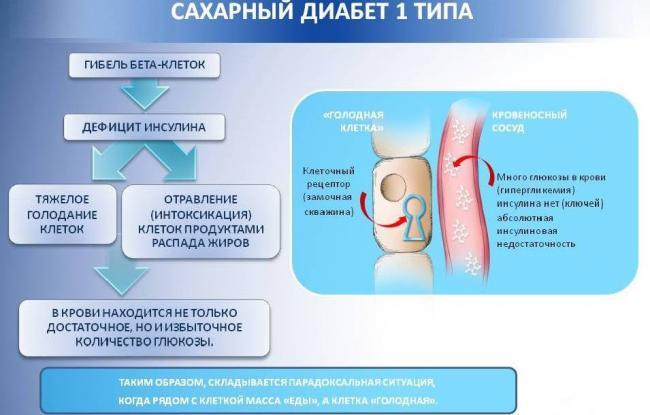 saharnyj-diabet-1-tipa.jpg