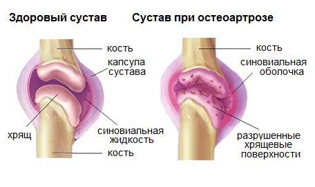 degeneratsiya-hryashha.jpg