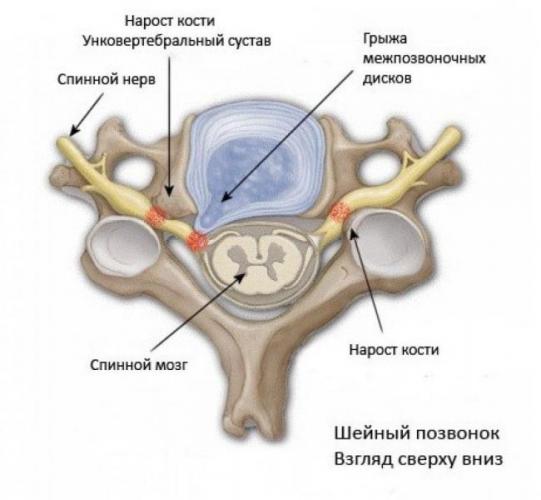 ris3-unkovertebralniy-artroz.jpg