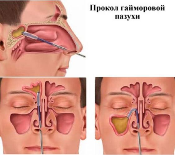 prokol-gaymorovoy-pazuhi-600x531.jpg
