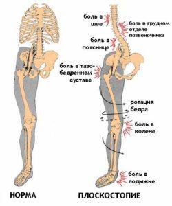 projavlenija-ploskostopija-250x300.jpg