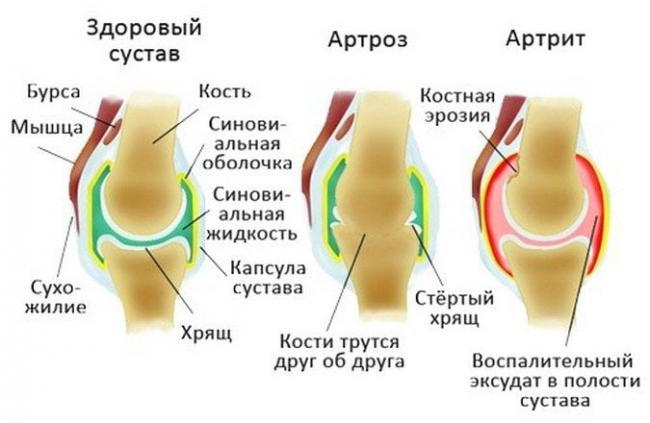 v-chem-raznica-artrit-i-artroz.jpg