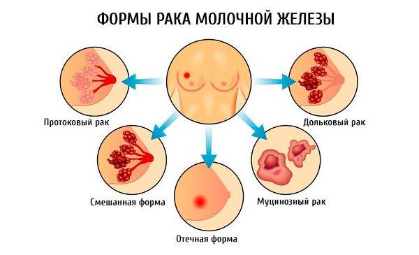 формы рака