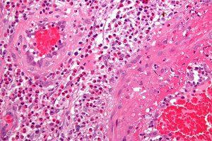 wikipedia-commons-1-17.churg-strauss_syndrome_-_very_high_mag-300x200.jpg