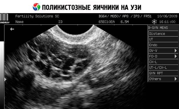 яичники на УЗИ