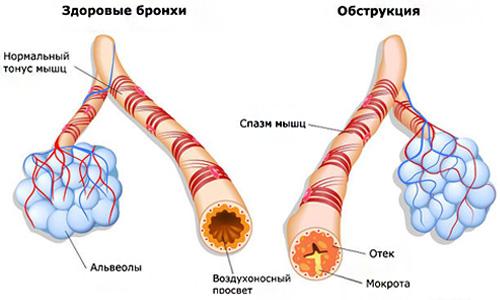 obstrukcija.jpg