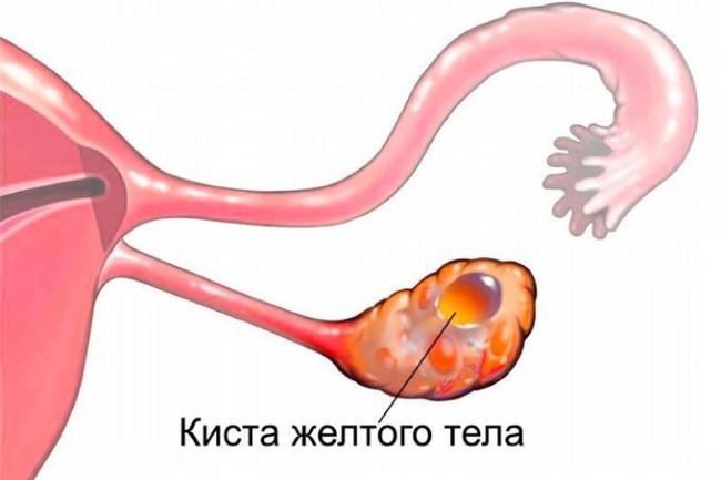 киста желтого тела