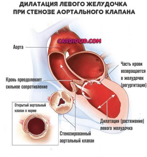 dilatatsiya-levogo-zheludochka.jpg