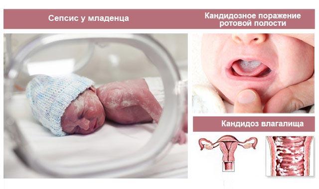 сепсис у младенца