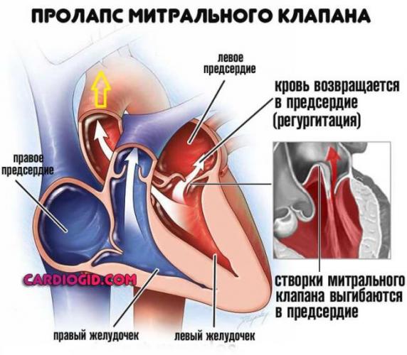 prolaps-mitralnogo-klapana.jpg