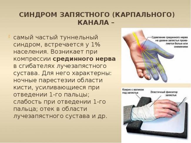 sindrom-zapyastnogo-kanala.jpg