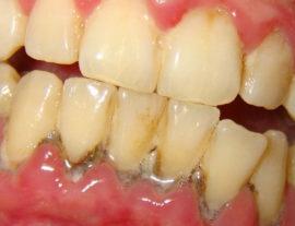 Gingivit-4-e1523836415964-270x207.jpg
