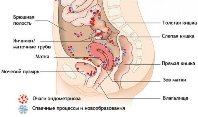 спаечные процессы при эндометриозе