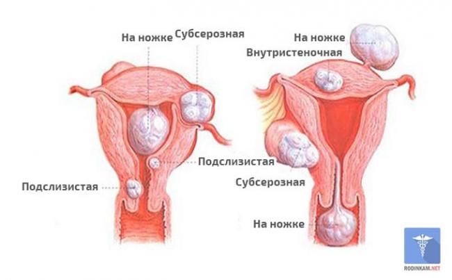 виды фибромы матки