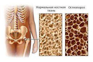 osteoporoz-2-300x200.jpg