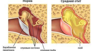 Otit_1_19144638-400x208.jpg