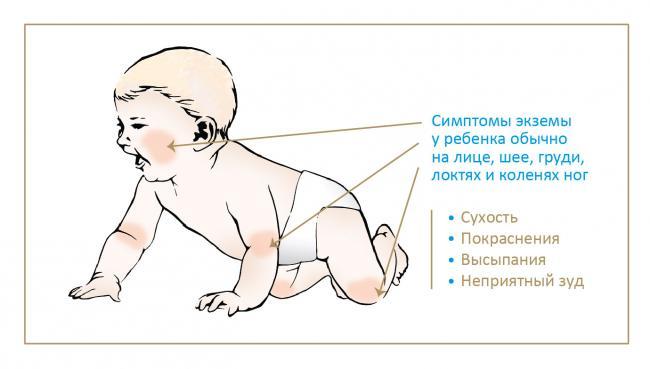 Симптомы экземы у ребенка