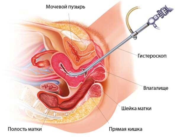 диагностическая гистероскопия перед эко