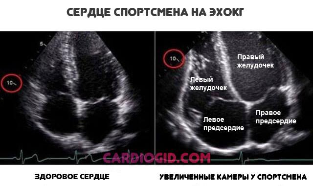 serdtse-sportsmena-na-ehokg.jpg