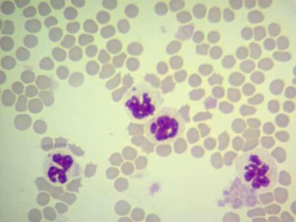 Причины возникновения токсической зернистости нейтрофилов, методы диагностики и лечения